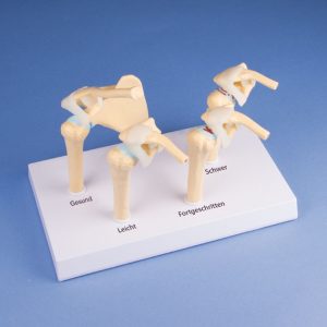The Four Stage Osteoarthritis Model of the Shoulder Joints