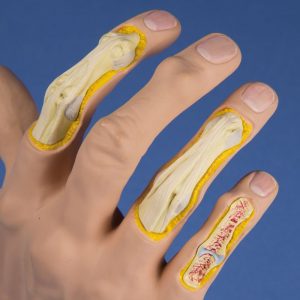Hand Osteoarthritis Model - Image 2