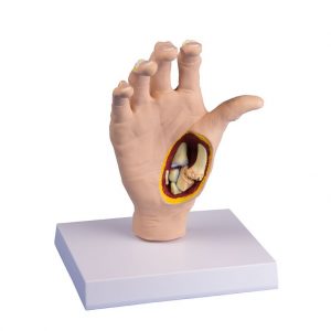 Hand Osteoarthritis Model