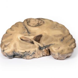 Metastatic Adenocarcinoma in the Brain