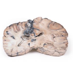 Cerebral Arterio Venous Malformation