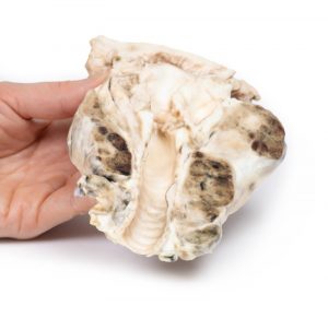 Multinodular Goitre - Image 3