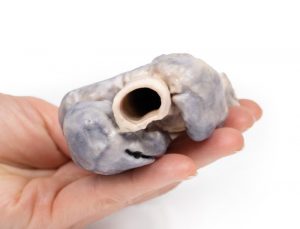Retrosternal Goiter - Image 4