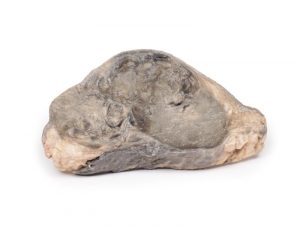 Carcinoma of Breast