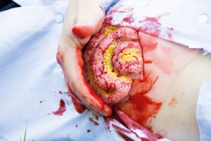 Wound Moulage Protruding Small Intestines - Image 8