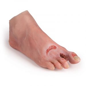 Wound Foot with Diabetic Foot Syndrome Severe Stage