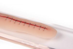 Surgical Wound with Staples 22cm