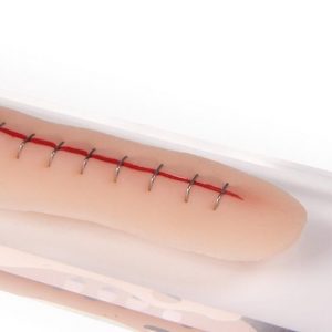 Surgical Wound with Staples 22cm