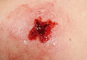 EZ Wounds Professional Wound Simulation Set - Image 8